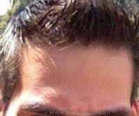Brow Lift / Fox Eye Lift Before & After Gallery - Patient 385984 - Image 1