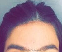 Brow Lift / Fox Eye Lift Before & After Gallery - Patient 385984 - Image 2