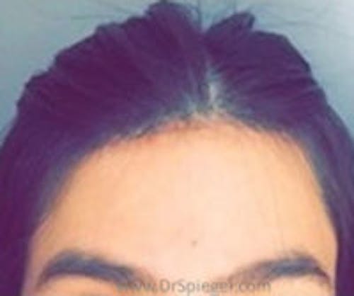 Brow Lift / Fox Eye Lift Before & After Gallery - Patient 385984 - Image 2