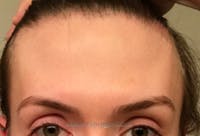 Brow Lift / Fox Eye Lift Before & After Gallery - Patient 276733 - Image 1