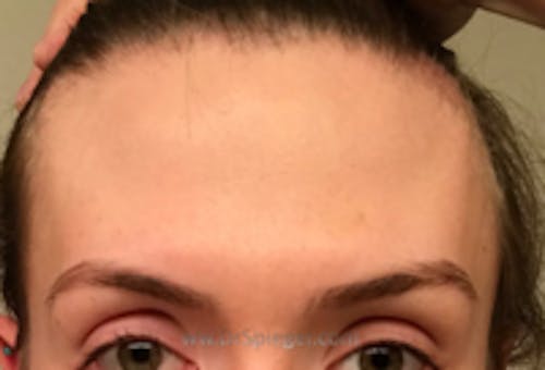 Brow Lift / Fox Eye Lift Before & After Gallery - Patient 276733 - Image 1