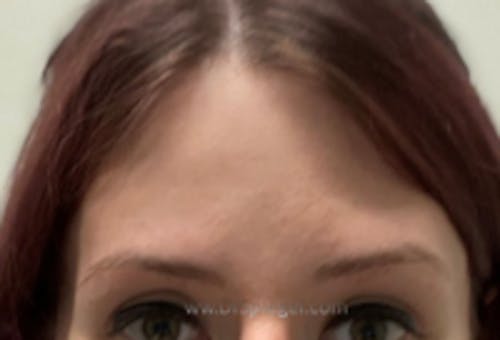 Brow Lift / Fox Eye Lift Before & After Gallery - Patient 276733 - Image 2