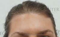 Brow Lift / Fox Eye Lift Before & After Gallery - Patient 709824 - Image 1