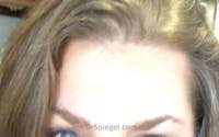 Brow Lift / Fox Eye Lift Before & After Gallery - Patient 709824 - Image 2