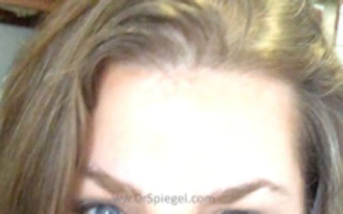 Brow Lift / Fox Eye Lift Before & After Gallery - Patient 709824 - Image 2