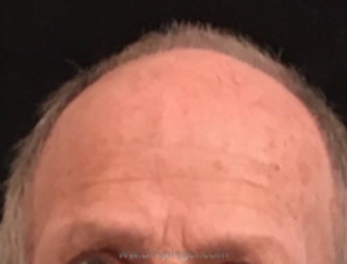 Brow Lift / Fox Eye Lift Before & After Gallery - Patient 126721 - Image 1