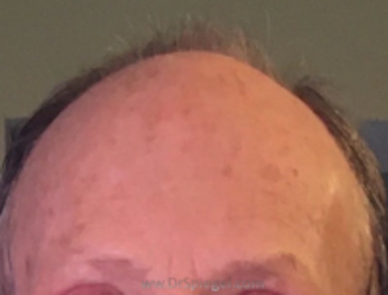Browlift / Fox Eye Lift Before & After Gallery - Patient 126721 - Image 2