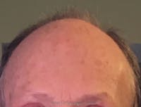 Brow Lift / Fox Eye Lift Before & After Gallery - Patient 126721 - Image 2