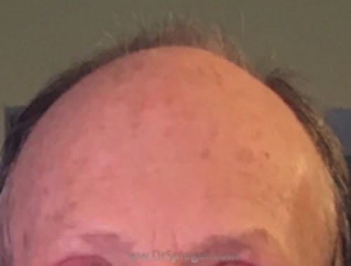 Brow Lift / Fox Eye Lift Before & After Gallery - Patient 126721 - Image 2