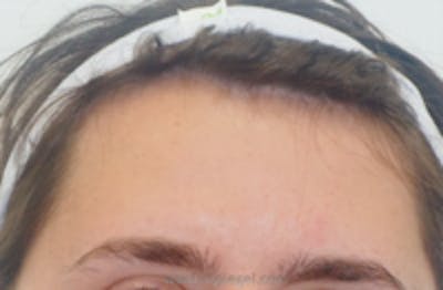 Browlift / Fox Eye Lift Before & After Gallery - Patient 376877 - Image 1
