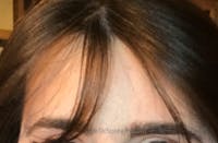 Brow Lift / Fox Eye Lift Before & After Gallery - Patient 376877 - Image 2