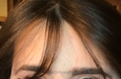 Browlift / Fox Eye Lift Before & After Gallery - Patient 376877 - Image 2