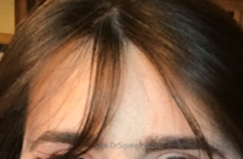 Brow Lift / Fox Eye Lift Before & After Gallery - Patient 376877 - Image 2