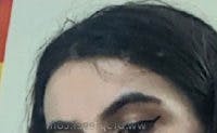 Brow Lift / Fox Eye Lift Before & After Gallery - Patient 263920 - Image 2