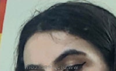 Browlift / Fox Eye Lift Before & After Gallery - Patient 263920 - Image 2