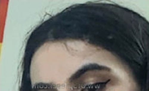Brow Lift / Fox Eye Lift Before & After Gallery - Patient 263920 - Image 2