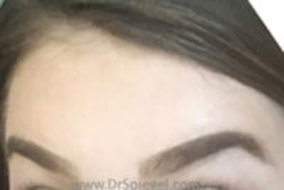 Browlift / Fox Eye Lift Before & After Gallery - Patient 192287 - Image 2