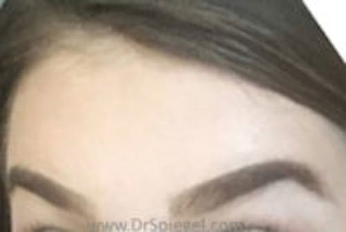 Brow Lift / Fox Eye Lift Before & After Gallery - Patient 192287 - Image 2