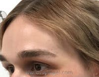 Brow Lift / Fox Eye Lift Before & After Gallery - Patient 410160 - Image 1
