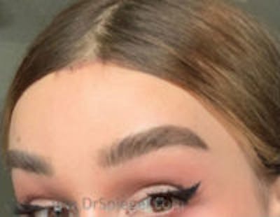 Browlift / Fox Eye Lift Before & After Gallery - Patient 410160 - Image 2