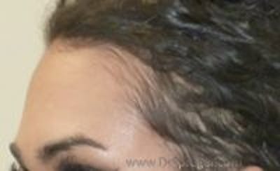 Browlift / Fox Eye Lift Before & After Gallery - Patient 199518 - Image 1
