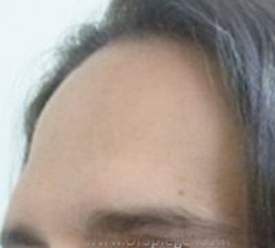 Browlift / Fox Eye Lift Before & After Gallery - Patient 244527 - Image 1