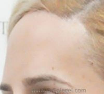 Browlift / Fox Eye Lift Before & After Gallery - Patient 244527 - Image 2