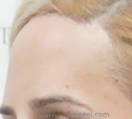 Brow Lift / Fox Eye Lift Before & After Gallery - Patient 244527 - Image 2
