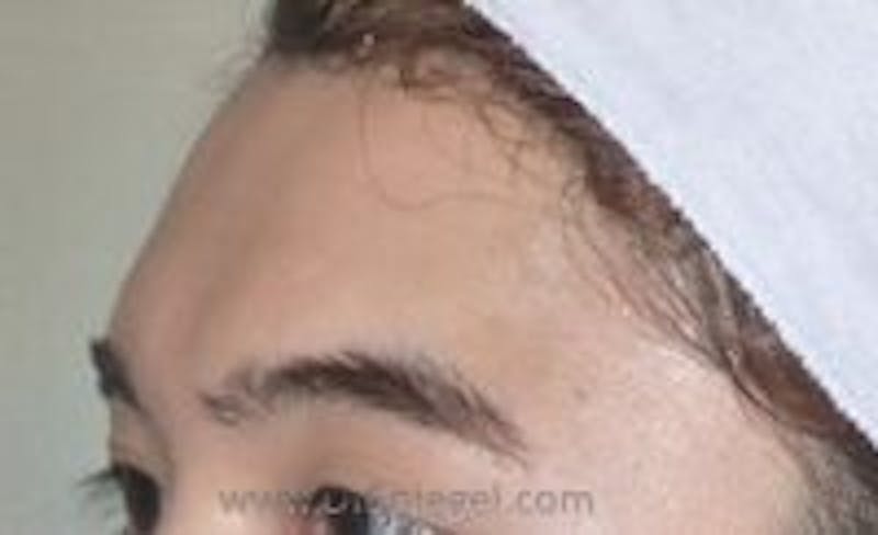 Browlift / Fox Eye Lift Before & After Gallery - Patient 362498 - Image 1