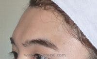 Brow Lift / Fox Eye Lift Before & After Gallery - Patient 362498 - Image 1