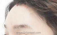 Brow Lift / Fox Eye Lift Before & After Gallery - Patient 362498 - Image 2