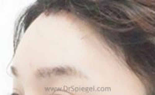 Brow Lift / Fox Eye Lift Before & After Gallery - Patient 362498 - Image 2
