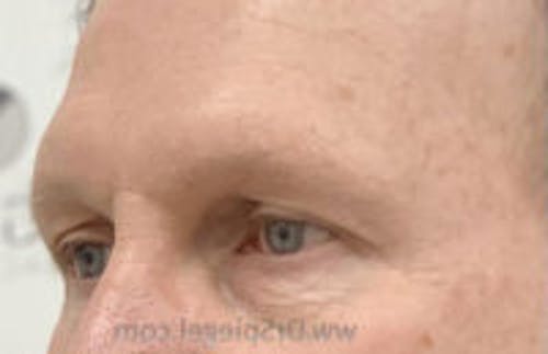 Brow Lift / Fox Eye Lift Before & After Gallery - Patient 197940 - Image 1