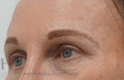 Browlift / Fox Eye Lift Before & After Gallery - Patient 197940 - Image 2