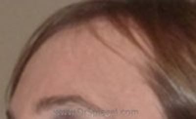 Browlift / Fox Eye Lift Before & After Gallery - Patient 364240 - Image 2