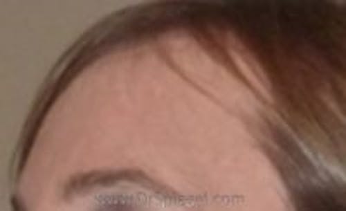 Brow Lift / Fox Eye Lift Before & After Gallery - Patient 364240 - Image 2