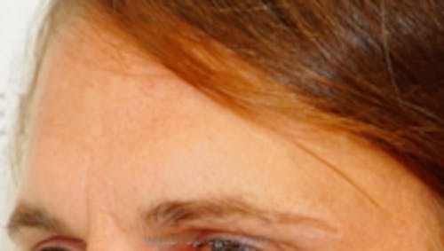 Brow Lift / Fox Eye Lift Before & After Gallery - Patient 569878 - Image 1