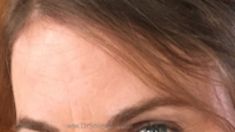 Browlift / Fox Eye Lift Before & After Gallery - Patient 569878 - Image 2