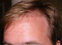 Brow Lift / Fox Eye Lift Before & After Gallery - Patient 134194 - Image 1