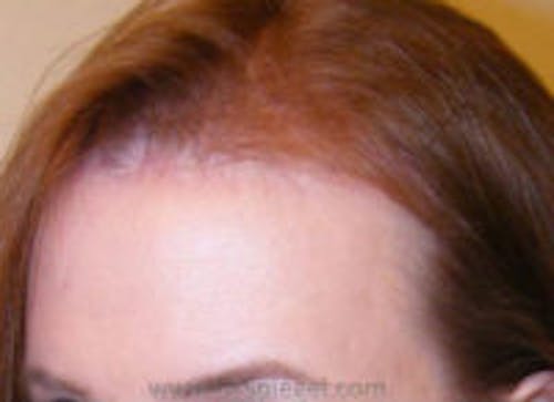 Brow Lift / Fox Eye Lift Before & After Gallery - Patient 134194 - Image 2