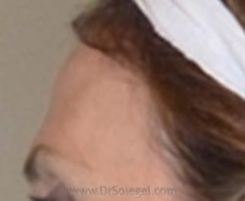 Brow Lift / Fox Eye Lift Before & After Gallery - Patient 177823 - Image 1