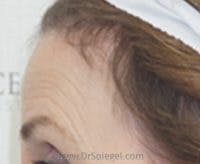 Brow Lift / Fox Eye Lift Before & After Gallery - Patient 177823 - Image 2