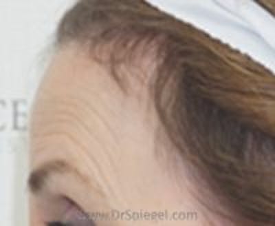 Browlift / Fox Eye Lift Before & After Gallery - Patient 177823 - Image 2