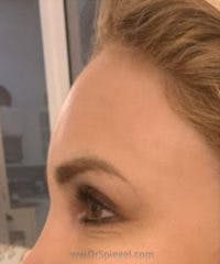 Brow Lift / Fox Eye Lift Before & After Gallery - Patient 299737 - Image 2
