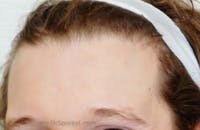 Brow Lift / Fox Eye Lift Before & After Gallery - Patient 356846 - Image 1