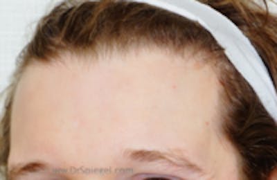 Browlift / Fox Eye Lift Before & After Gallery - Patient 356846 - Image 1