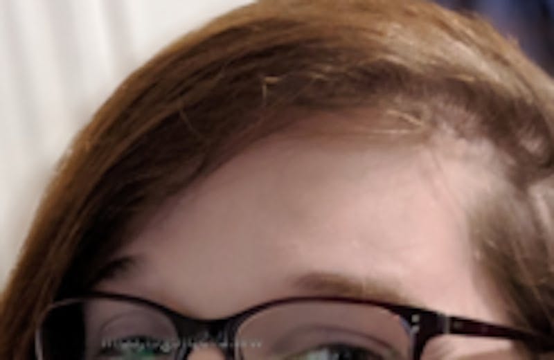 Browlift / Fox Eye Lift Before & After Gallery - Patient 356846 - Image 2