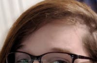 Brow Lift / Fox Eye Lift Before & After Gallery - Patient 356846 - Image 2