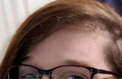 Browlift / Fox Eye Lift Before & After Gallery - Patient 356846 - Image 2