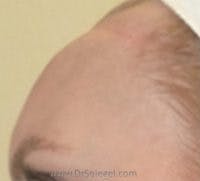 Brow Lift / Fox Eye Lift Before & After Gallery - Patient 254513 - Image 1